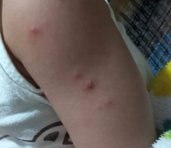 A FVS-RCP reforçou orientações de prevenção contra a doença mão-pé-boca, uma infecção viral contagiosa que atinge principalmente crianças.