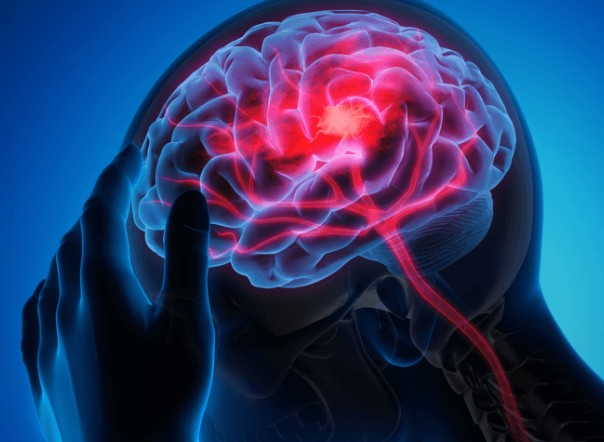AVC mata uma pessoa a cada 6 minutos no Brasil. Entenda sintomas, fatores de risco, custos hospitalares e como prevenir o derrame cerebral.