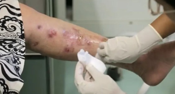 O Amazonas registrou a primeira morte por esporotricose em 2025, além de quase 1,5 mil casos da doença.