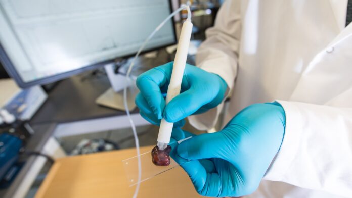 Uma caneta detectora de câncer, que 'lê' tecidos e identifica tumores em 90 segundos, iniciou testes clínicos no Brasil pelo Hospital Albert Einstein.