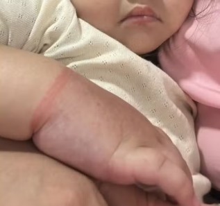 Criança de 2 anos quase perdeu o braço em Manaus após elástico de cabelo interromper a circulação.