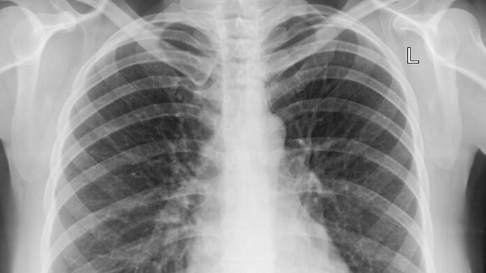 A pneumonia está entre as doenças que mais matam no mundo. Saiba sintomas, formas de prevenção e fatores de risco.