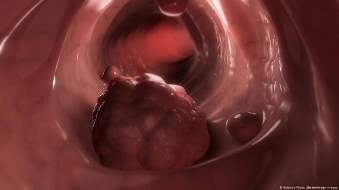 O câncer colorretal avança entre jovens abaixo de 50 anos.