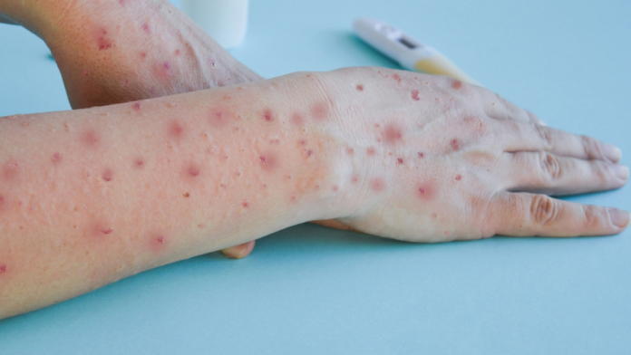 O Brasil registra 90 casos confirmados de Mpox com avanço em Minas Gerais e Paraná.