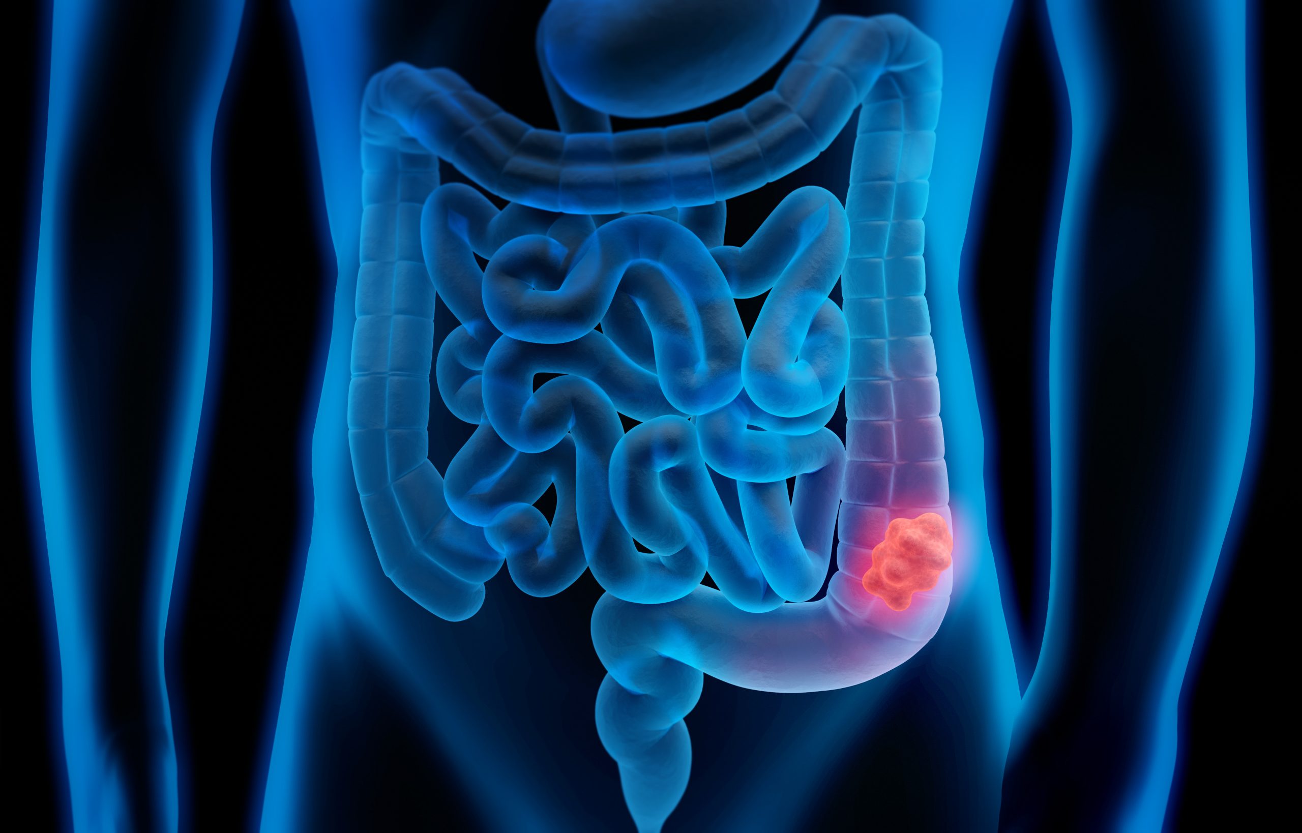 Câncer de intestino tem exames triplicados no SUS com avanço do Março Azul e maior conscientização sobre diagnóstico precoce.