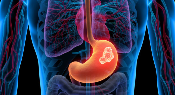 Saiba como pesquisadores brasileiros usam o suco gástrico para identificar o câncer de estômago e aumentar a precisão da endoscopia em casos complexos.
