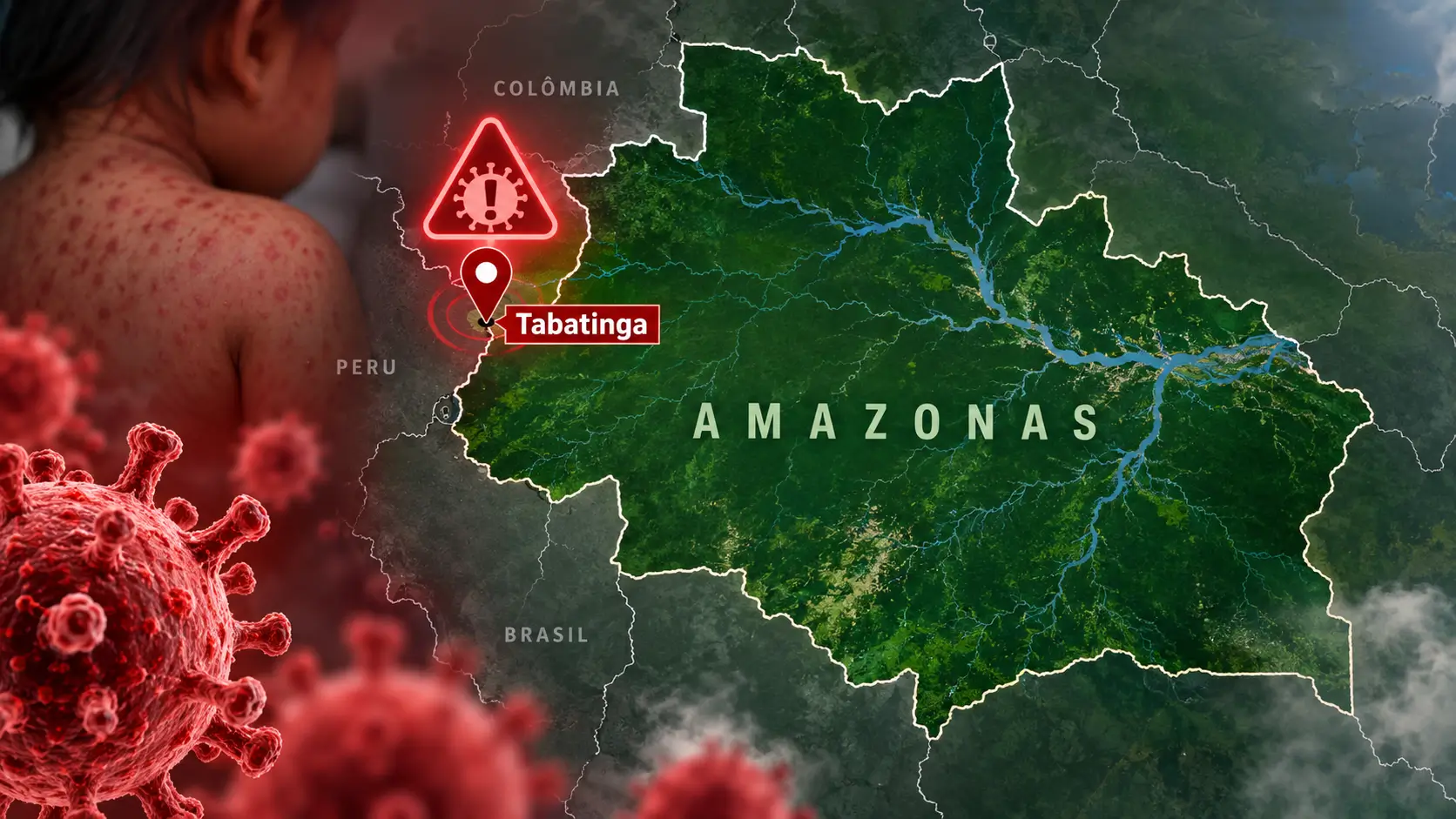 Sarampo no Amazonas chega a quatro casos em Tabatinga. Novo caso é de criança peruana de 2 anos sem histórico de vacinação.